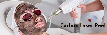 Carbon Laser Peel