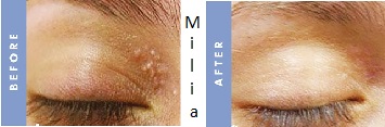 Milia Seed and White Spot Removal