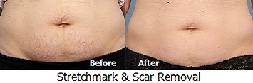 Stretch Mark Removal Treatments