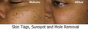 Skin Tags and Mole Removal